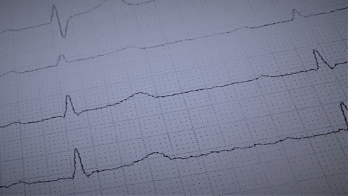 EKG1